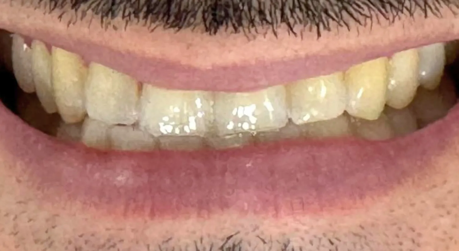 Antes do tratamento — Clareamento dentário