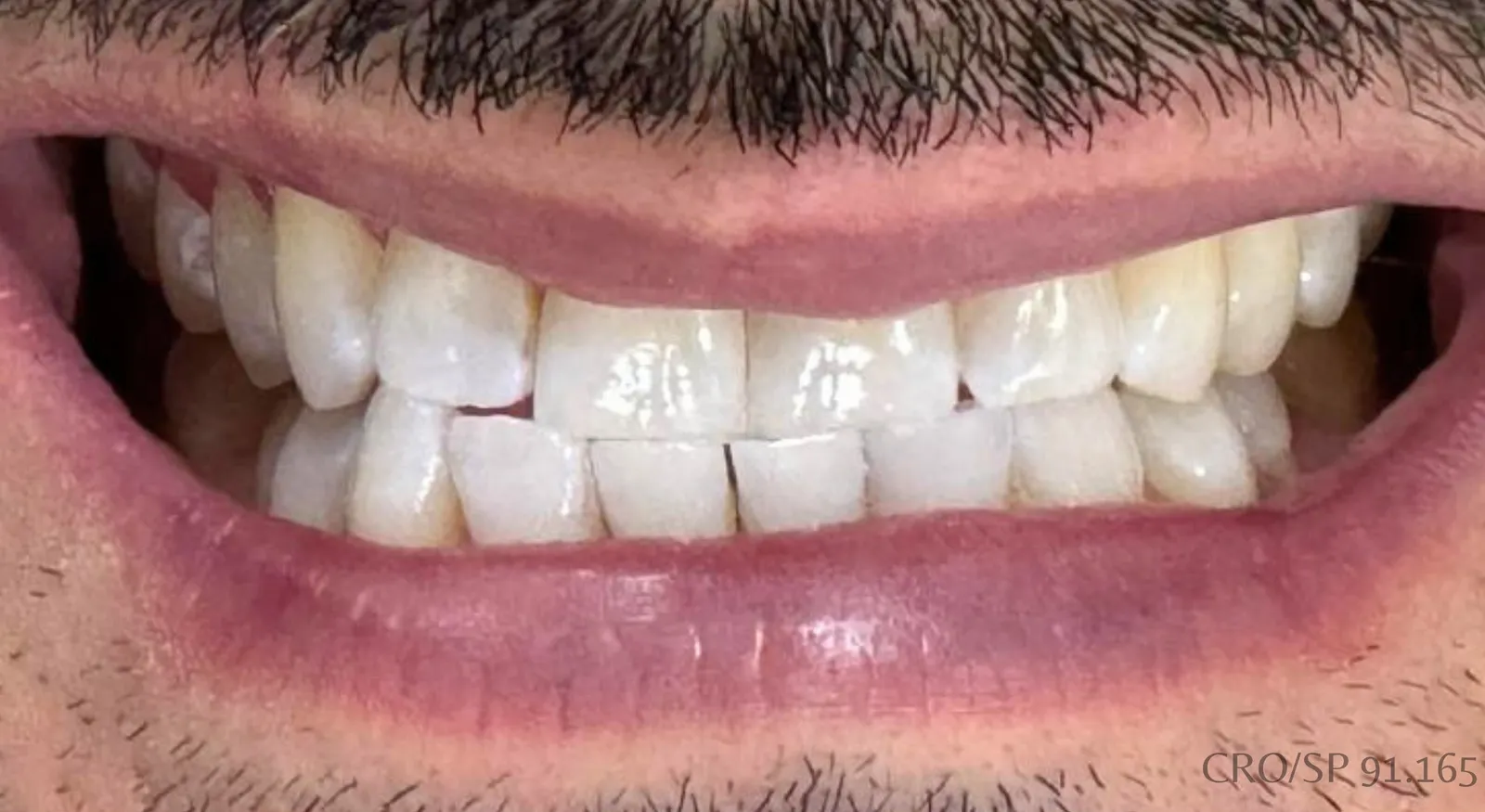 Depois do tratamento — Clareamento dentário